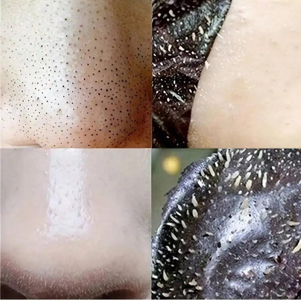Effective Blackhead Remover Nose Strips For Deep Pore Cleansing