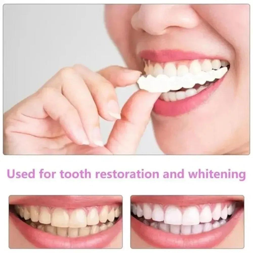 Temporary Snap On Veneers for Upper and Lower Teeth